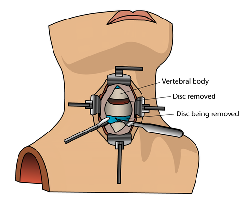 Fremre cervikal diskektomi - Foto Wikimedia